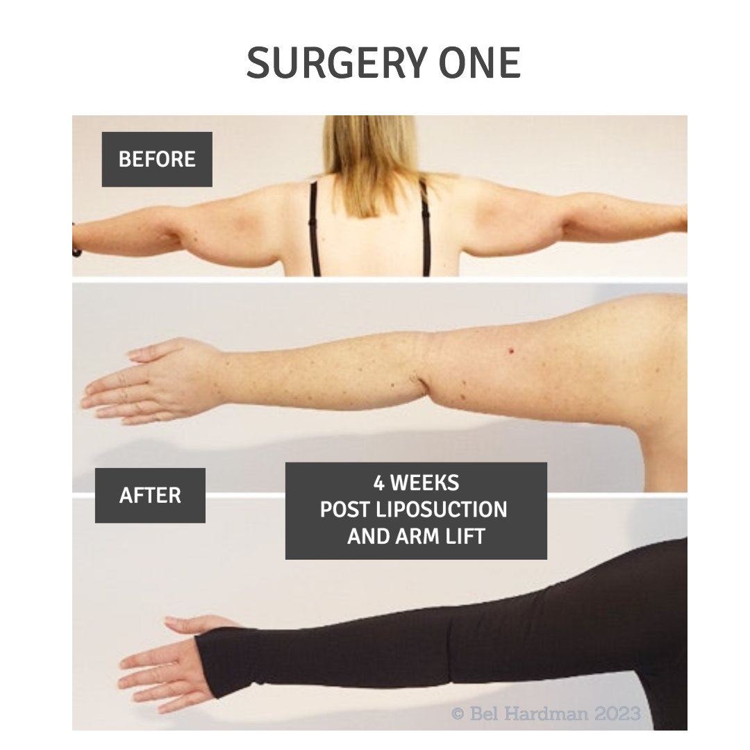 My 12 Month Lipoedema Surgery Journey PhysioPod UK Ltd Exclusive UK My 12 Month Lipoedema Surgery Journey PhysioPod UK Ltd Exclusive UK